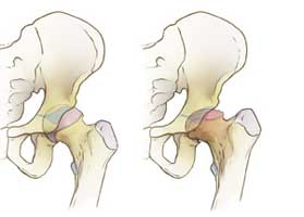 سیاه شدن سر استخوان ران در لگن