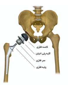 مفصل مصنوعی لگن