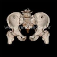 دررفتگی سمفیز پوبیس و مفصل ساکروایلیاک لگن