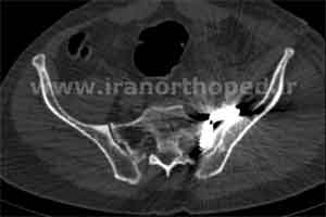 دررفتگی سمفیز پوبیس و مفصل ساکروایلیاک لگن