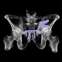 دررفتگی سمفیز پوبیس و مفصل ساکروایلیاک لگن