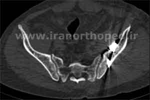 دررفتگی سمفیز پوبیس و مفصل ساکروایلیاک لگن