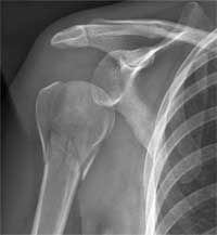  شکستگی چند قطعه ای گردن استخوان بازو همراه با دررفتگی مفصل شانه
