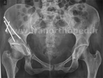 رادیوگرافی جراحی نیمه دررفتگی مفصل ران در ناحیه لگن