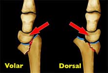 شکستگی دررفتگی مچ دست بارتون