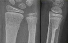  شکستگی باکل یا توروس در انتهای پایینی استخوان رادیوس