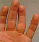  دررفتگی بند میانی انگشت انگشتری