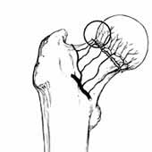 آسیب به خونرسانی سر استخوان ران بعد از شکستگی گردن استخوان فمور