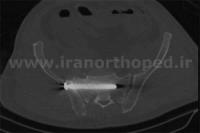 دررفتگی سمفیز پوبیس و مفصل ساکروایلیاک لگن