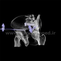 دررفتگی سمفیز پوبیس و مفصل ساکروایلیاک لگن