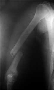  شکستگی تنه استخوان بازو