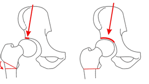 استئوتومی لگن