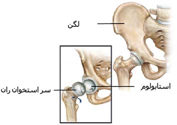 سر استخوان ران و حفره استابولوم در ناحیه لگن