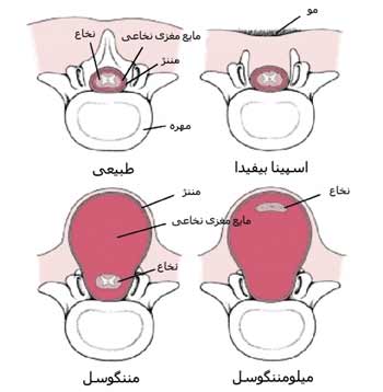 اسپاینا بیفیدا