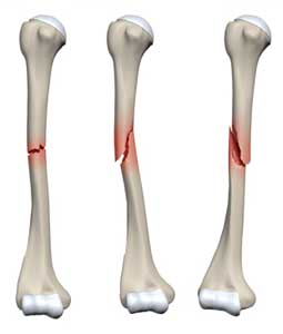  شکستگی های مایل و عرضی تنه استخوان بازو