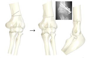 استئوتومی بالای آرنج برای تصحیح کوبیتوس واروس