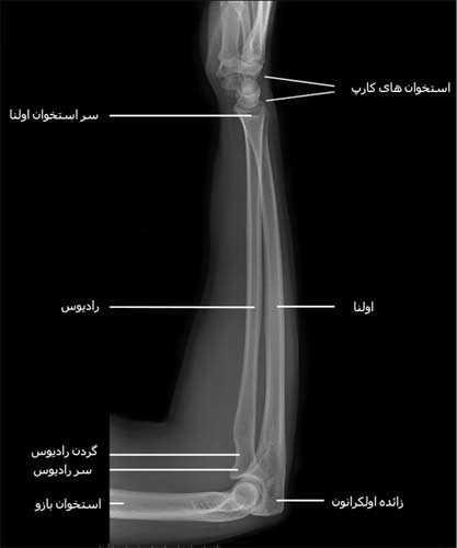  رادیوگرافی نیمرخ از استخوان های ساعد
