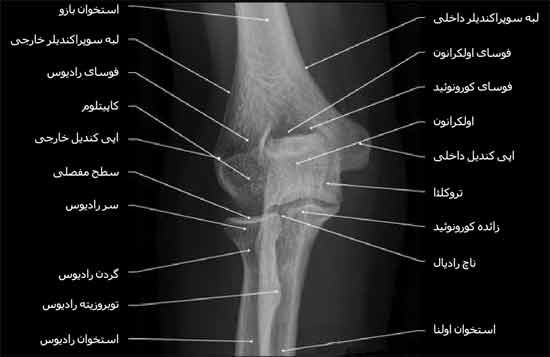  رادیوگرافی رخ مفصل آرنج