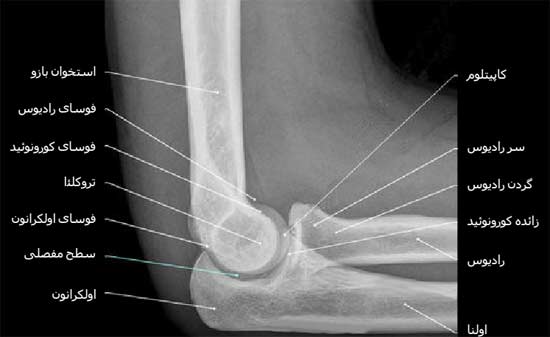 رادیوگرافی نیمرخ مفصل آرنج