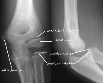 رادیوگرافی رخ و نیمرخ مفصل آرنج در قبل از بلوغ