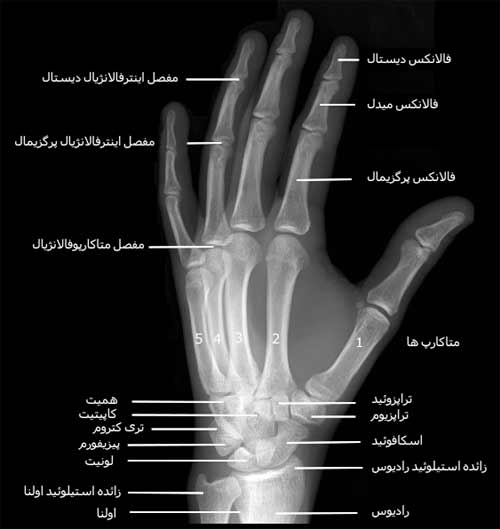  رادیوگرافی مایل دست