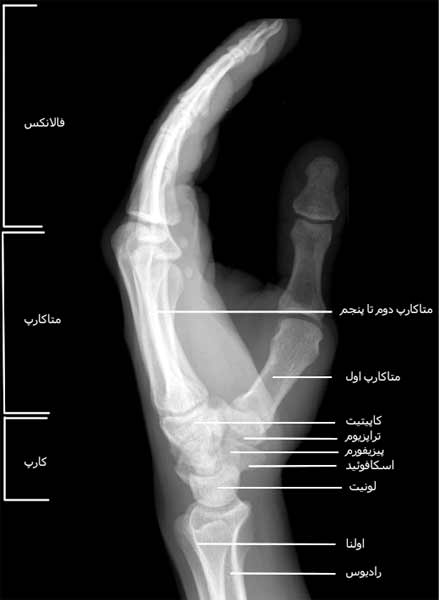 رادیوگرافی نیمرخ دست