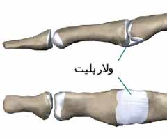 رباط های انگشت دست