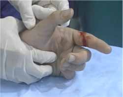  بریدگی سطح ولار انگشت میتواند موجب آسیب تاندون فلکسور آن شود