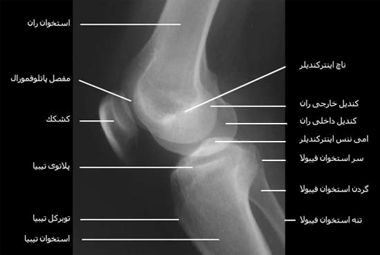  رادیوگرافی نیمرخ مفصل زانو