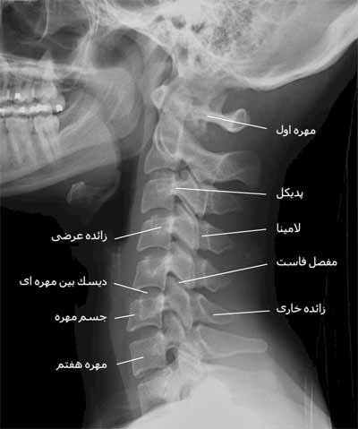  رادیوگرافی نیمرخ ستون مهره گردنی