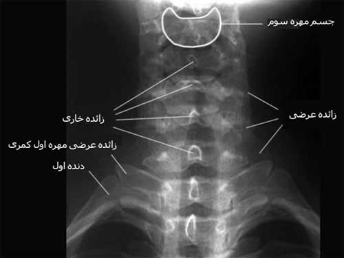 رادیوگرافی رخ ستون مهره گردنی