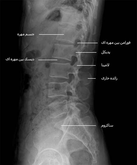  رادیوگرافی نیمرخ ستون مهره کمری