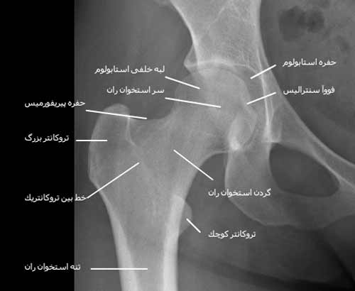 رادیوگرافی رخ مفصل ران