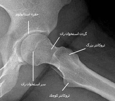 رادیوگرافی نیمرخ مفصل ران.