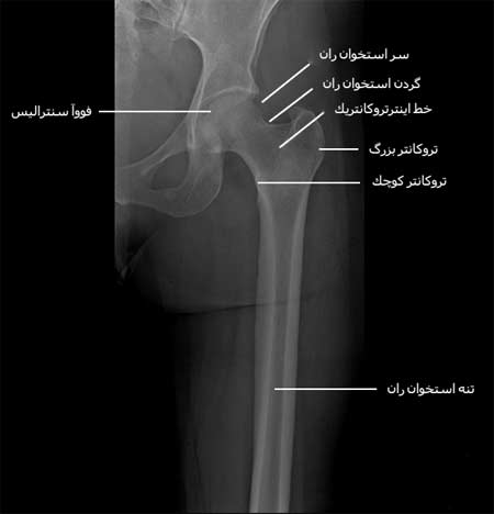   رادیوگرافی رخ قسمت های وسط و بالای ران