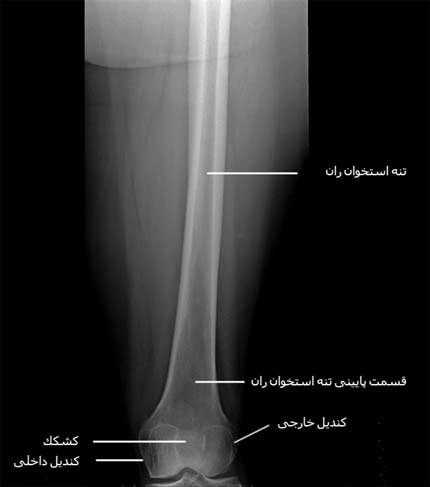  رادیوگرافی رخ قسمت های وسط و پایین ران