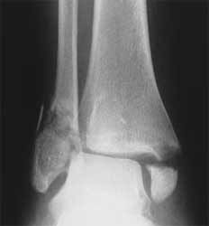  یک شکستگی دو قوزکی در مچ پا