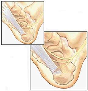 جراحی درد پاشنه