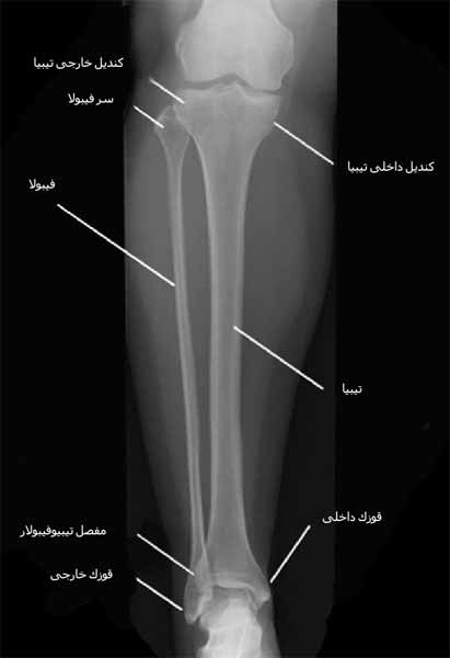 رادیوگرافی رخ ساق