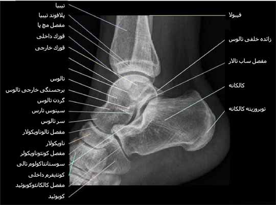  رادیوگرافی نیمرخ یا لترال مچ پا