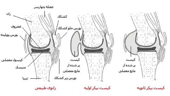 کیست بیکر