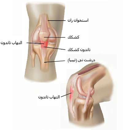 تاندنیت کشکک یا التهاب تاندون کشکک