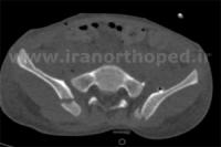 دررفتگی مفاصل ساکروایلیاک لگن