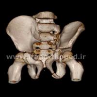 دررفتگی مفاصل ساکروایلیاک لگن