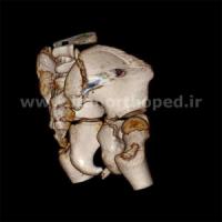 دررفتگی مفاصل ساکروایلیاک لگن