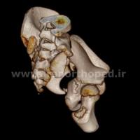 دررفتگی مفاصل ساکروایلیاک لگن