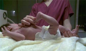  در رفتگی مادرزادی مفصل زانو در نوزاد