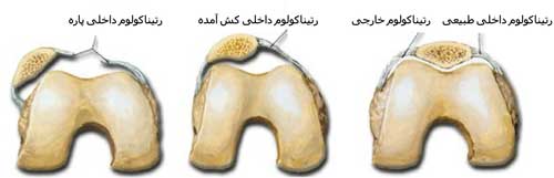 ناپایداری کشکک