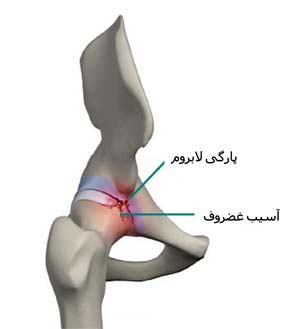 پارگی لابروم مفصل ران در لگن