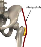 بورسیت تروکانتر در لگن